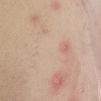 Molfix Bezleri Alerji Sorunu Yaratıyor