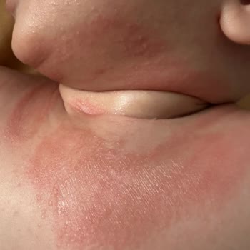 Mustela Ürünleri Bebeğimde Egzama Yaptı