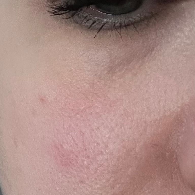 Ciltte Yanma Ve Kuruluk Yapan Güneş Kremi