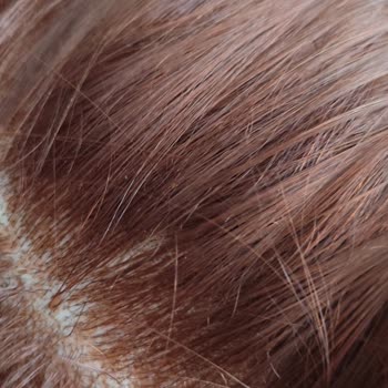 Saç Boyası Kabusu: Yanma Ve Kaşıntı Sorunu