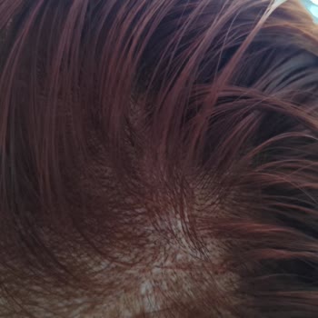 Saç Boyası Kabusu: Yanma Ve Kaşıntı Sorunu