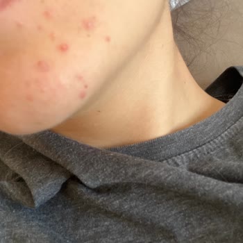 Yves Rocher Anti AGE Global Serum Cilt Sorunlarına Yol Açtı