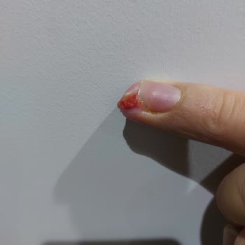 Sada Hastanesi Neşter İle Yapılacak İşlemi Lazer İle Yapmaya Çalıştılar!