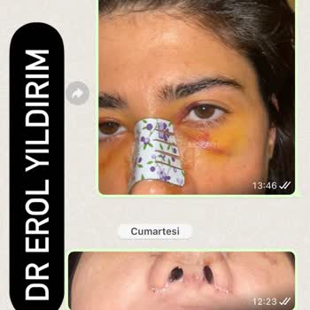 Başarısız Burun Ameliyatı Ve Kötü Davranışlar
