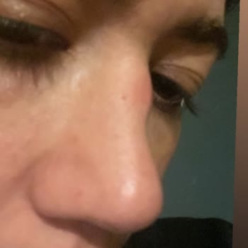 Başarısız Burun Ameliyatı Ve Kötü Davranışlar