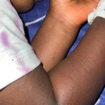 Sebamed Baby Product Caused Severe Skin Reaction Requiring Hospital Visit