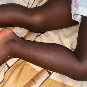 Sebamed Baby Product Caused Severe Skin Reaction Requiring Hospital Visit