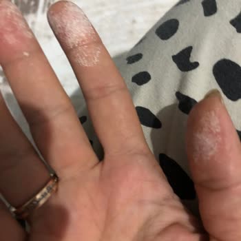 Vanish Kosla Kullanımı Sonrası Cilt Yanması Ve Uyuşma