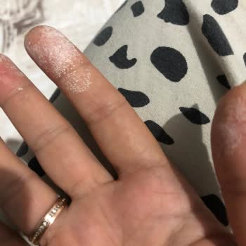 Vanish Kosla Kullanımı Sonrası Cilt Yanması Ve Uyuşma