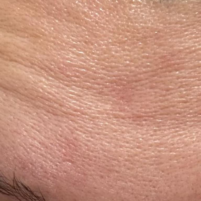 Başarısız Botox Uygulaması Ve Baş Ağrısı Sorunu