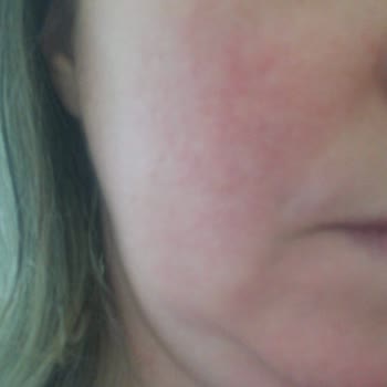 Yanlış Ürün Tavsiyesi İle Artan Cilt Sorunları