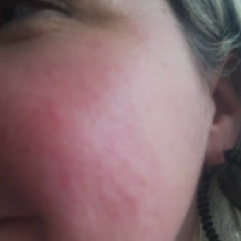 Yanlış Ürün Tavsiyesi İle Artan Cilt Sorunları