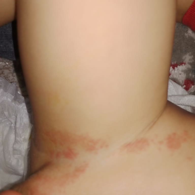 Molfix Pure & Soft Bezi Oğlumda Ciddi Pişiğe Neden Oldu