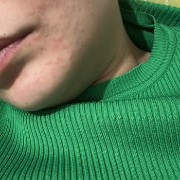 Trendyol Cilt Vitamini Kızarıklık Sorunu