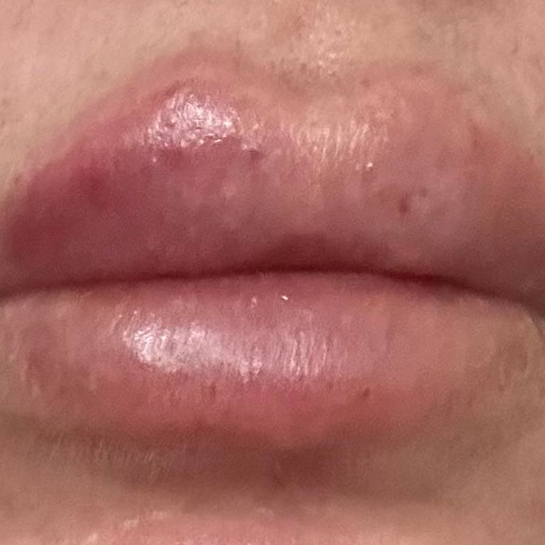 Fedederm Güzellik Merkezi Dolgu İşlemi Memnuniyetsizliği!