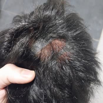 20.000 TL'lik Saç Döküldü, Üretim Hatası Kabul Edilmiyor