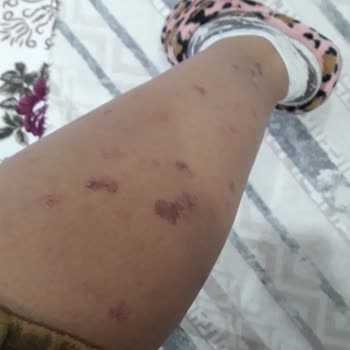 Lazer Tedavisi Sonrası Yanıklar Ve İade Sorunu