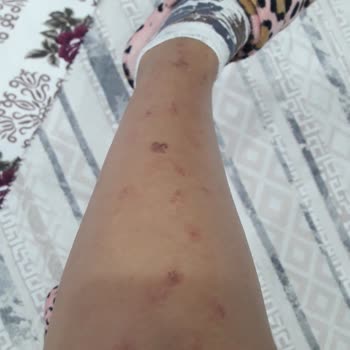 Lazer Tedavisi Sonrası Yanıklar Ve İade Sorunu