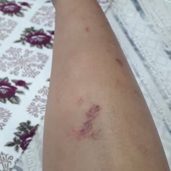 Lazer Tedavisi Sonrası Yanıklar Ve İade Sorunu