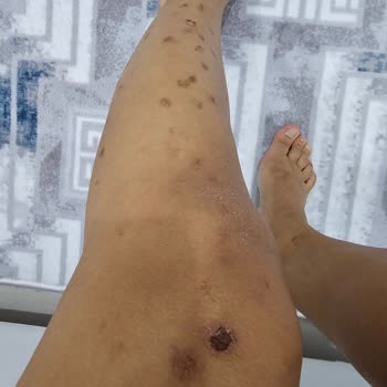 Lazer Tedavisi Sonrası Yanıklar Ve İade Sorunu