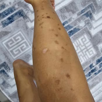 Lazer Tedavisi Sonrası Yanıklar Ve İade Sorunu