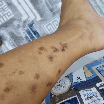 Lazer Tedavisi Sonrası Yanıklar Ve İade Sorunu