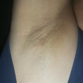 Deotak Krem Kullanımı Sonrası Cilt Sorunları