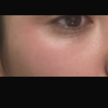 Effaclar Duo Seti İle Cilt Sorunları