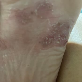 Ayakkabı Kullanımı Sonrası Ayağımda Derin Yaralar Oluştu