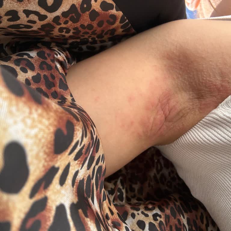 Roll-on Kullanımı Sonrası Beklenmedik Alerjik Reaksiyon