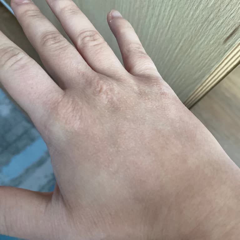 Antibakteriyel Sabun Ellerimi Mahvetti