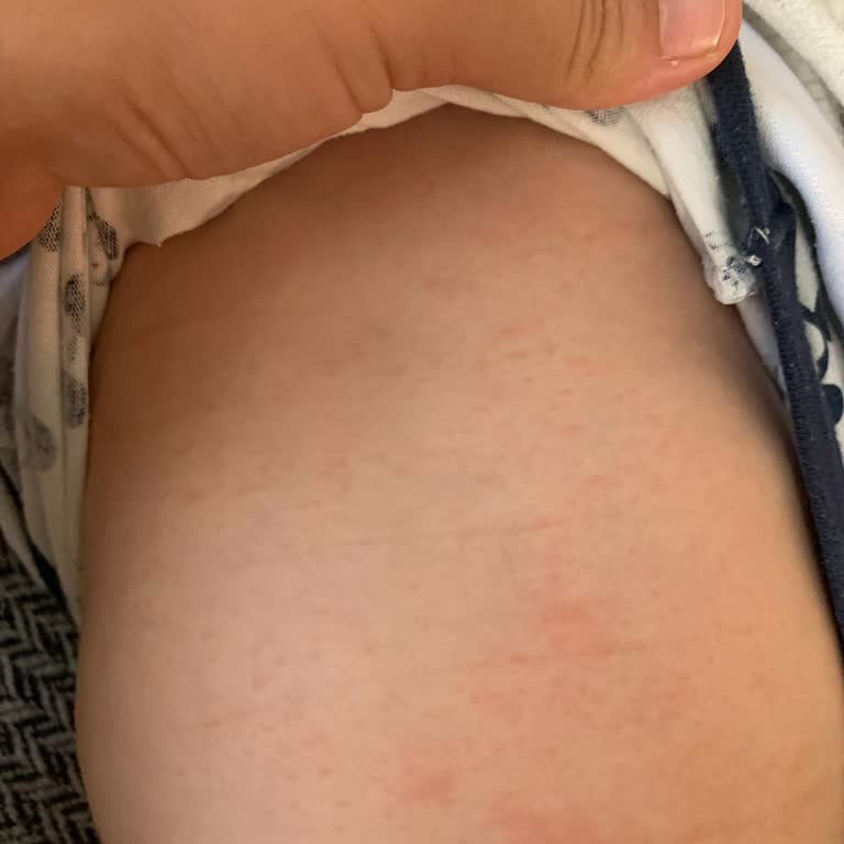 Sebamed Vücut Losyonu Bebeğimin Cildinde Sorun Yarattı