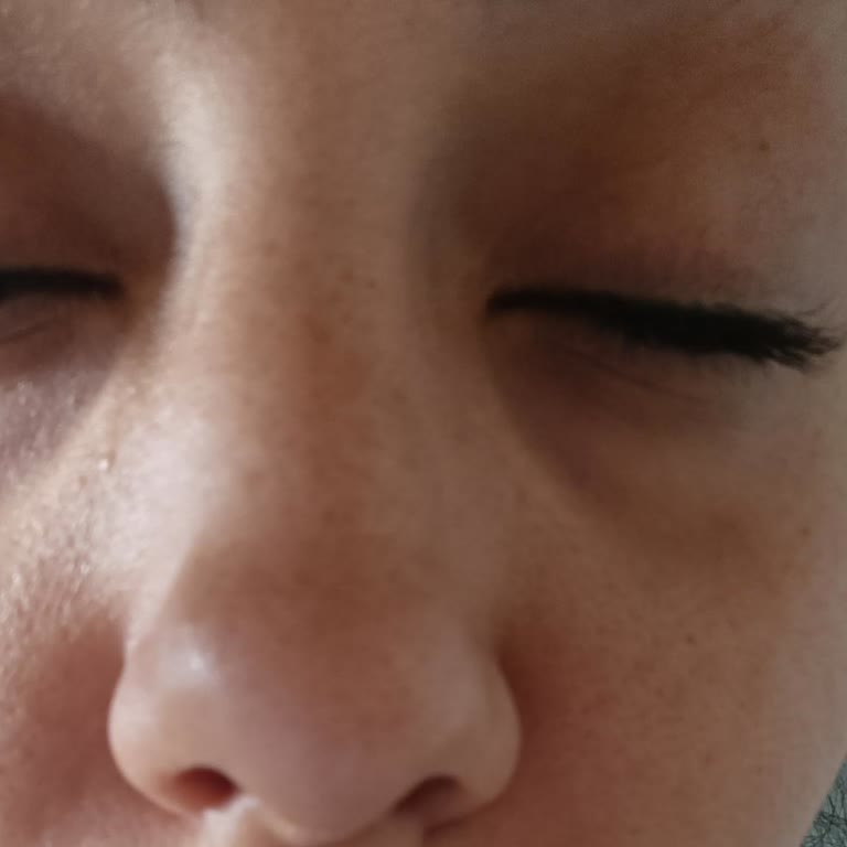 Yüz Dolgusu Sonrası Sürekli Devam Eden Sorunlar Ve Yetersiz Çözüm