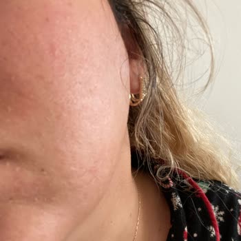 Ciltte Yanık Etkisi Yapan C Vitamini Kapsülleri