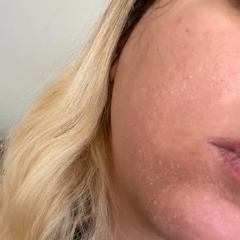 Ciltte Yanık Etkisi Yapan C Vitamini Kapsülleri