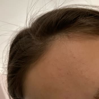 Bioderma Atoderm Krem Cilt Sorunlarına Yol Açtı