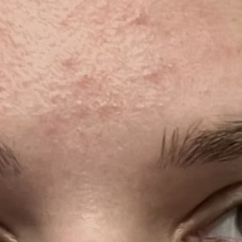 SHE Vec Serumları Cilt Sorunlarına Yol Açıyor