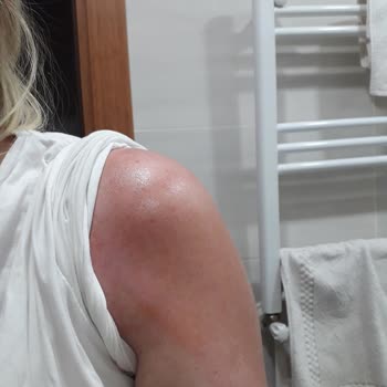 Thermoflex Krem Kullanımında Cilt Reaksiyonu Sorunu