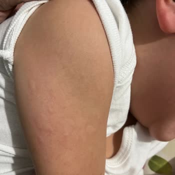 Çocuğumun Sağlığı Tehlikede: Yanlış Tedavi Sonucu Alerjik Reaksiyon