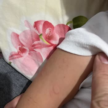 Çocuğumun Sağlığı Tehlikede: Yanlış Tedavi Sonucu Alerjik Reaksiyon