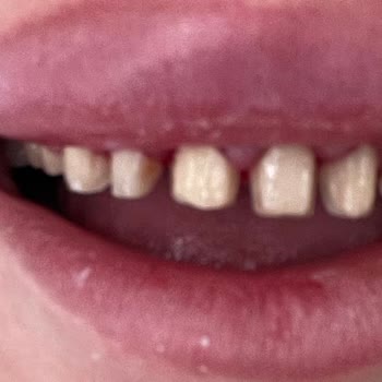 Klinik Viyana'da Diş Kabusu: Estetik Lamine Yerine Sorunlu Kaplama