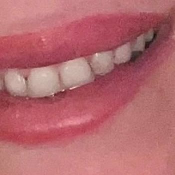 Klinik Viyana'da Diş Kabusu: Estetik Lamine Yerine Sorunlu Kaplama