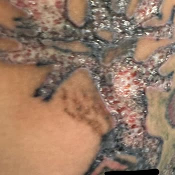 Yanlış Uygulama Sonrası İyileşmeyen Yaralar