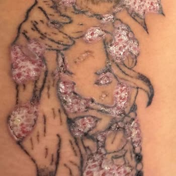 Yanlış Uygulama Sonrası İyileşmeyen Yaralar