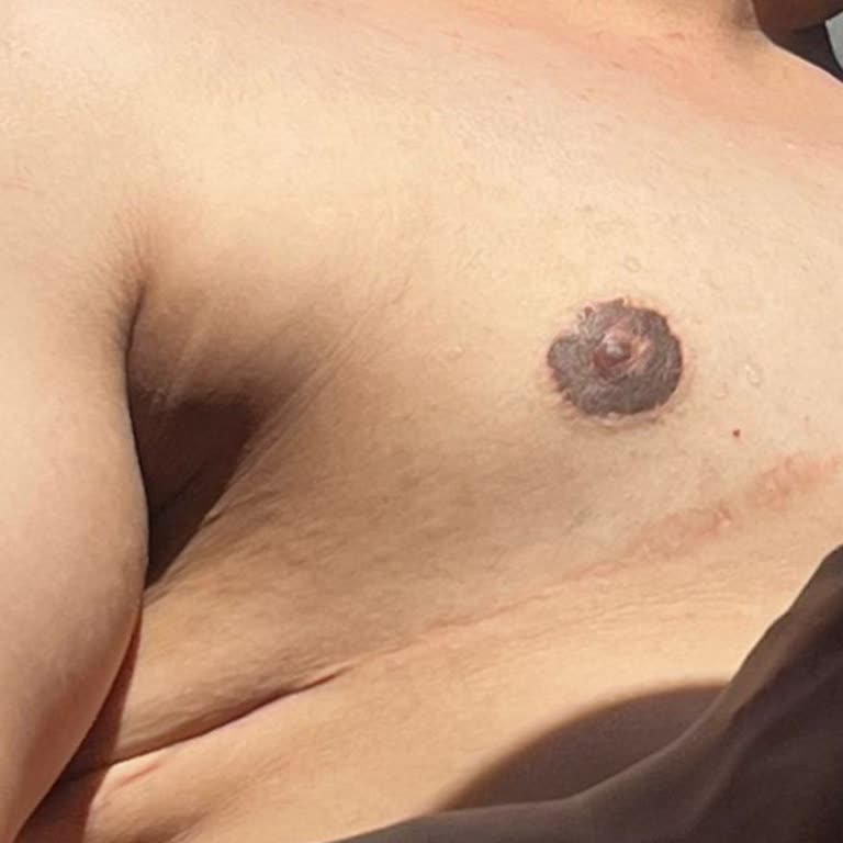 Estetik Ameliyat Sonrası Hayal Kırıklığı