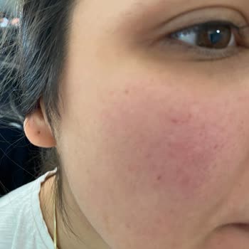 Yanlış Ürün Ve Ciltte Yan Etki Şoku