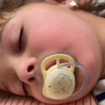 Mustela Ürünleri Atopik Dermatiti Kötüleştirdi