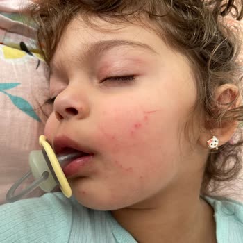 Mustela Ürünleri Atopik Dermatiti Kötüleştirdi