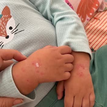 Mustela Ürünleri Atopik Dermatiti Kötüleştirdi