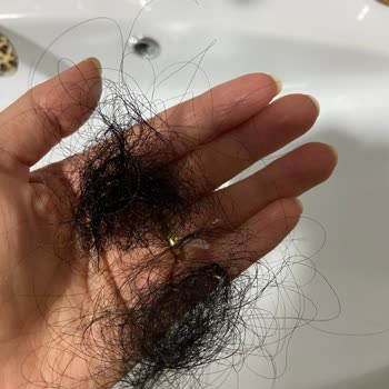 Egzama Ve Saç Dökülmesi Yapan Şampuan